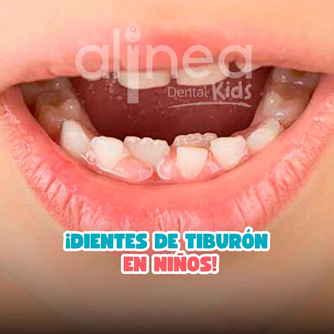DIENTES DE TUBURÓN EN NIÑOS