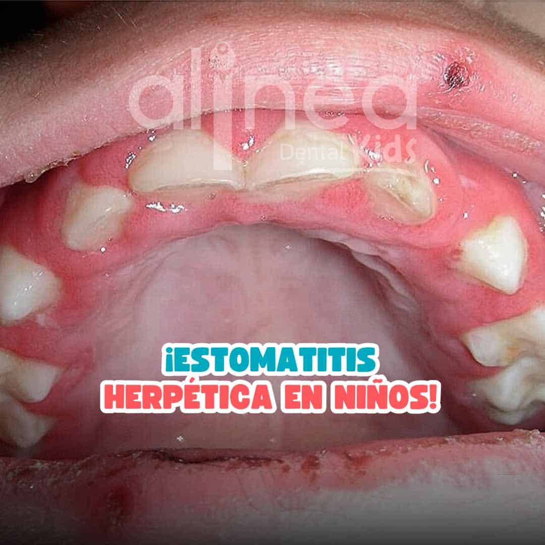 Estomatitis Herpética en Niños