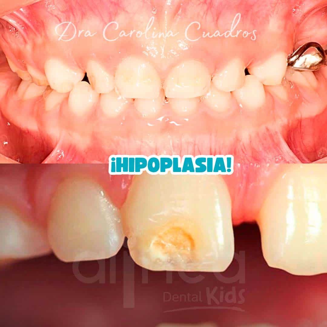 Hipoplasia