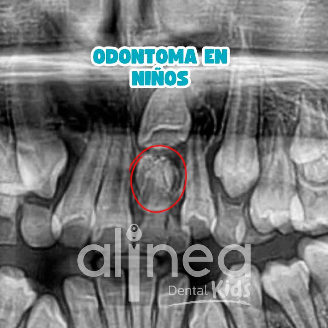ODONTOMA EN NIÑOS_