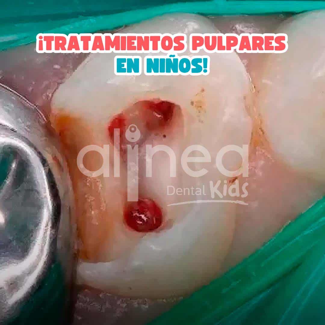 TRATAMIENTO PULPAR_