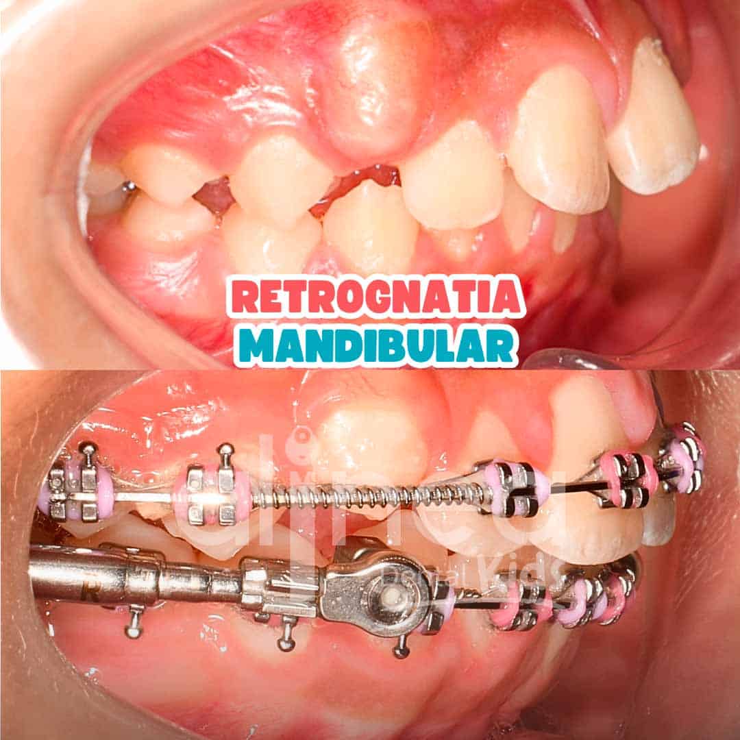retrognatia mandibular