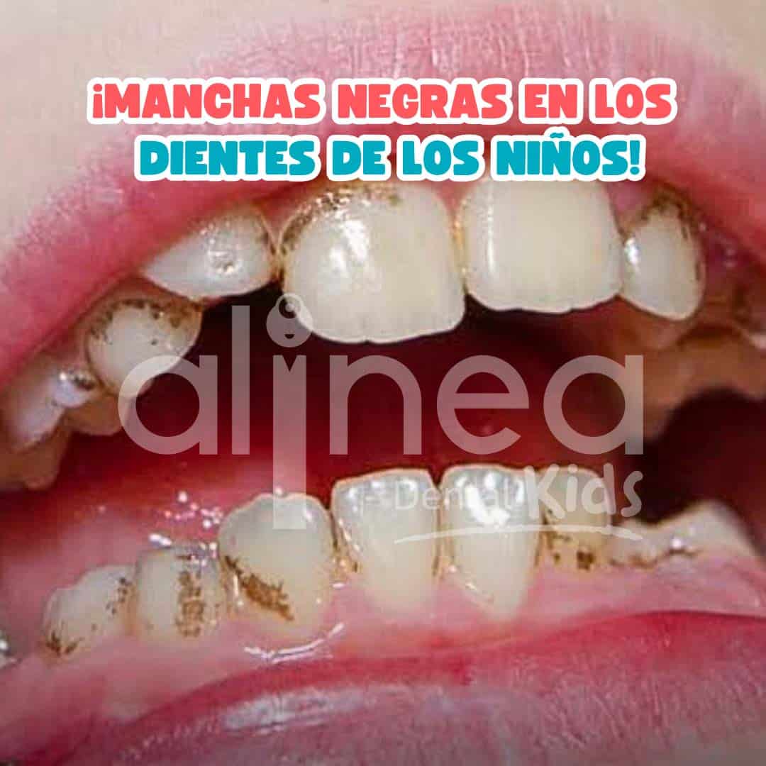 MANCHAS NEGRAS EN DIENTES_