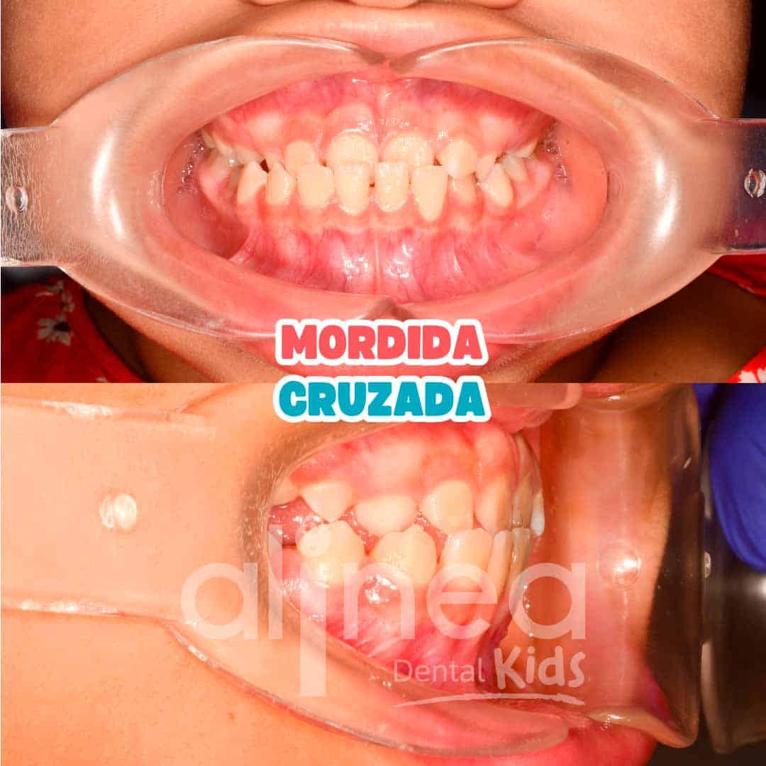MORDIDA CRUZADA_