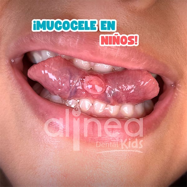 MUCOCELE EN NIÑOS