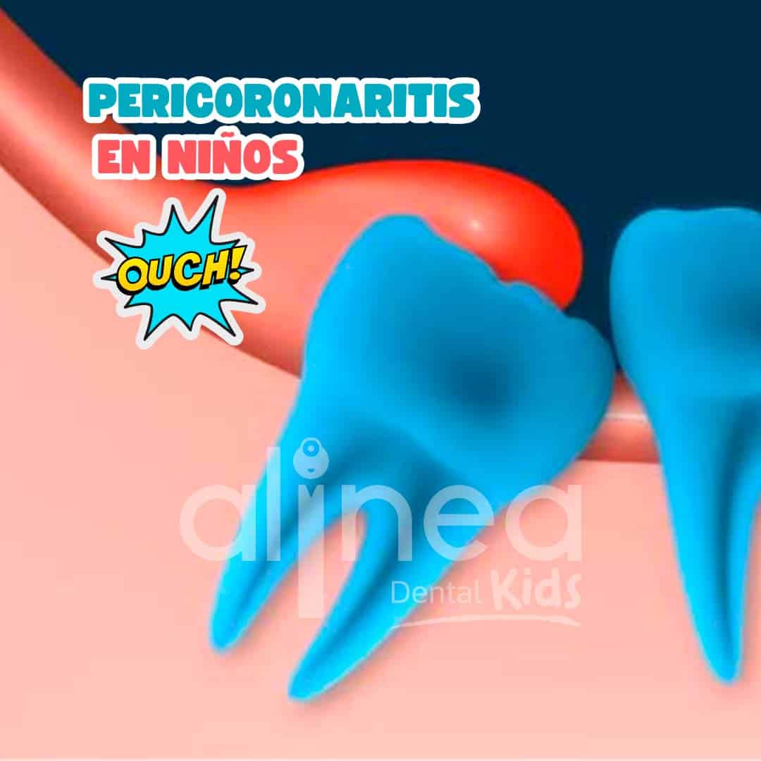 PERICORONARITIS EN NIÑOS_