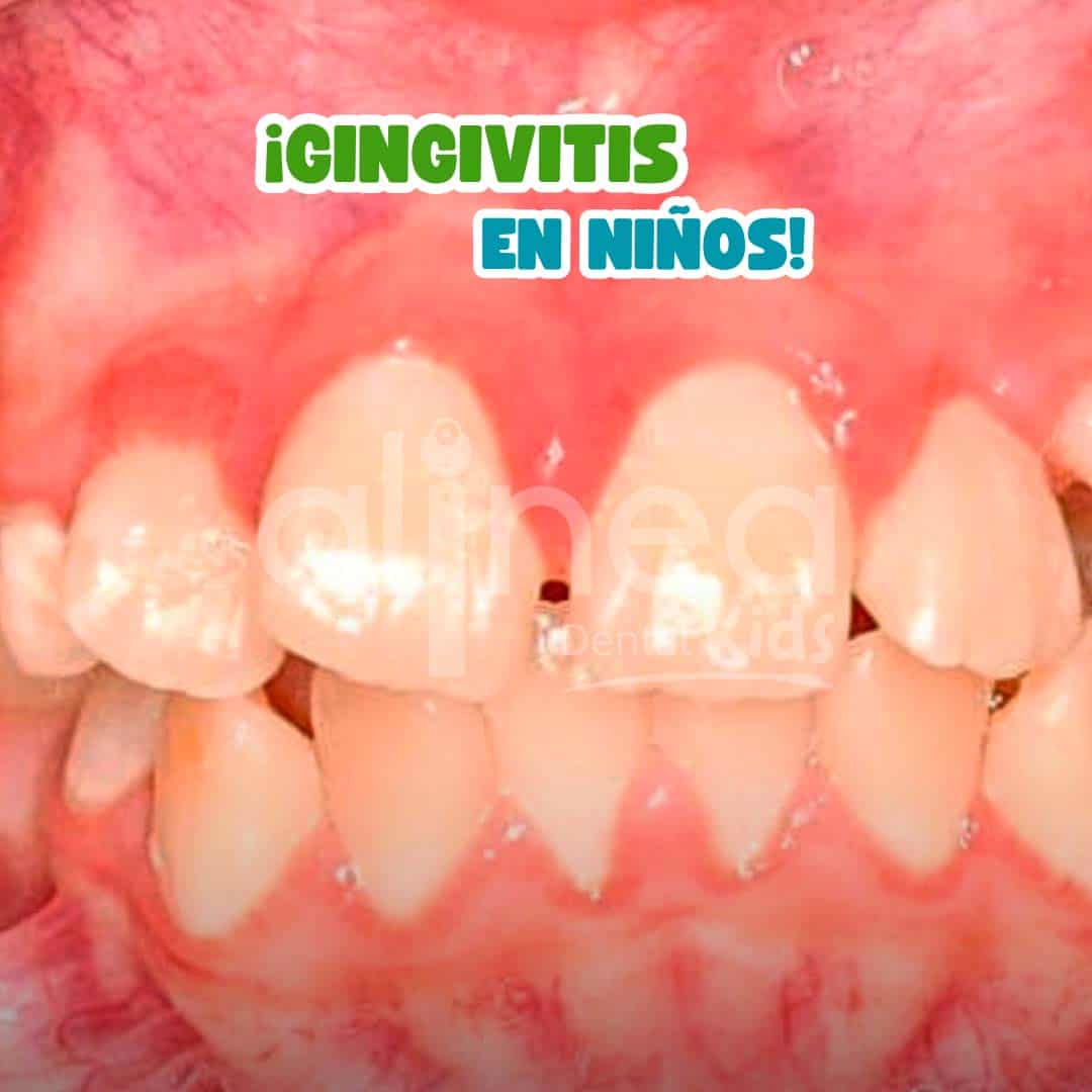 GINGIVITIS EN NIÑOS_