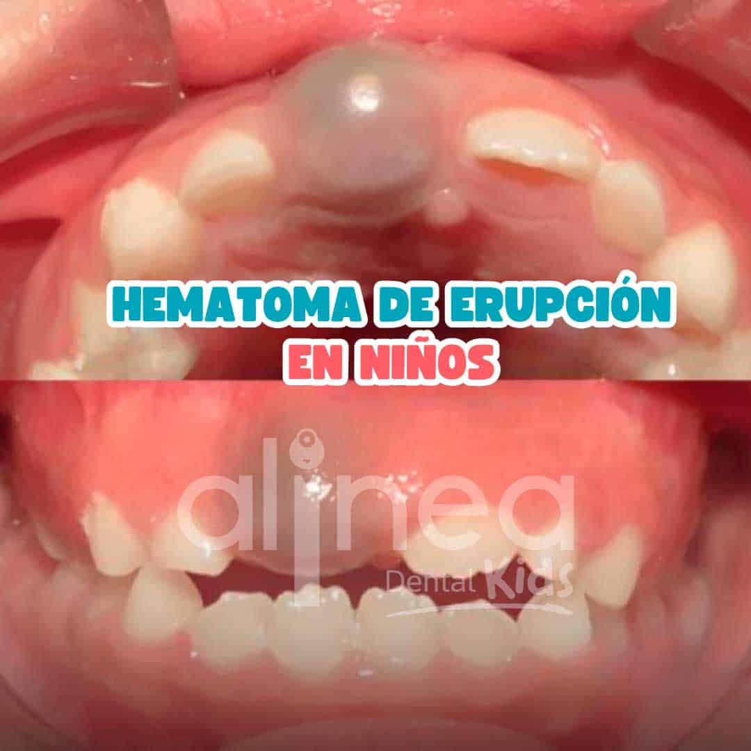 HEMATOMA-DE-ERUPCIÓN-