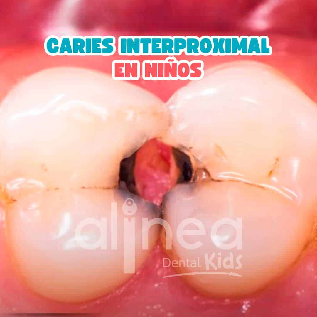 CARIES-INTERPROXIMAL-EN-NIÑOS-