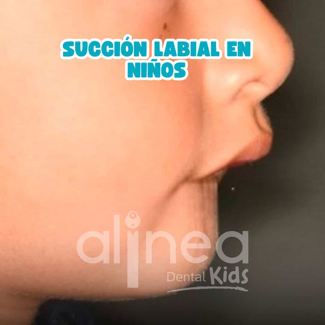 SUCCIÓN-LABIAL-EN-NIÑOS-
