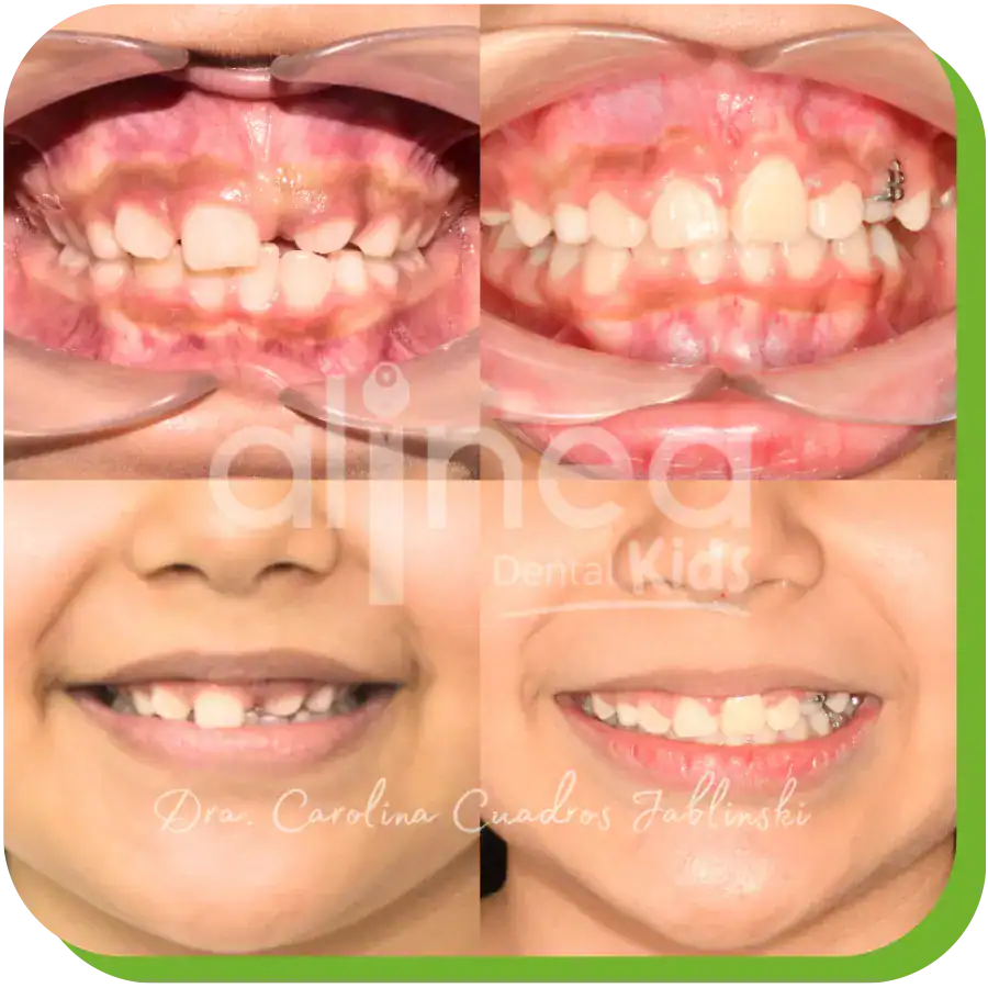 caso dientes retenidos dentista lima peru 1