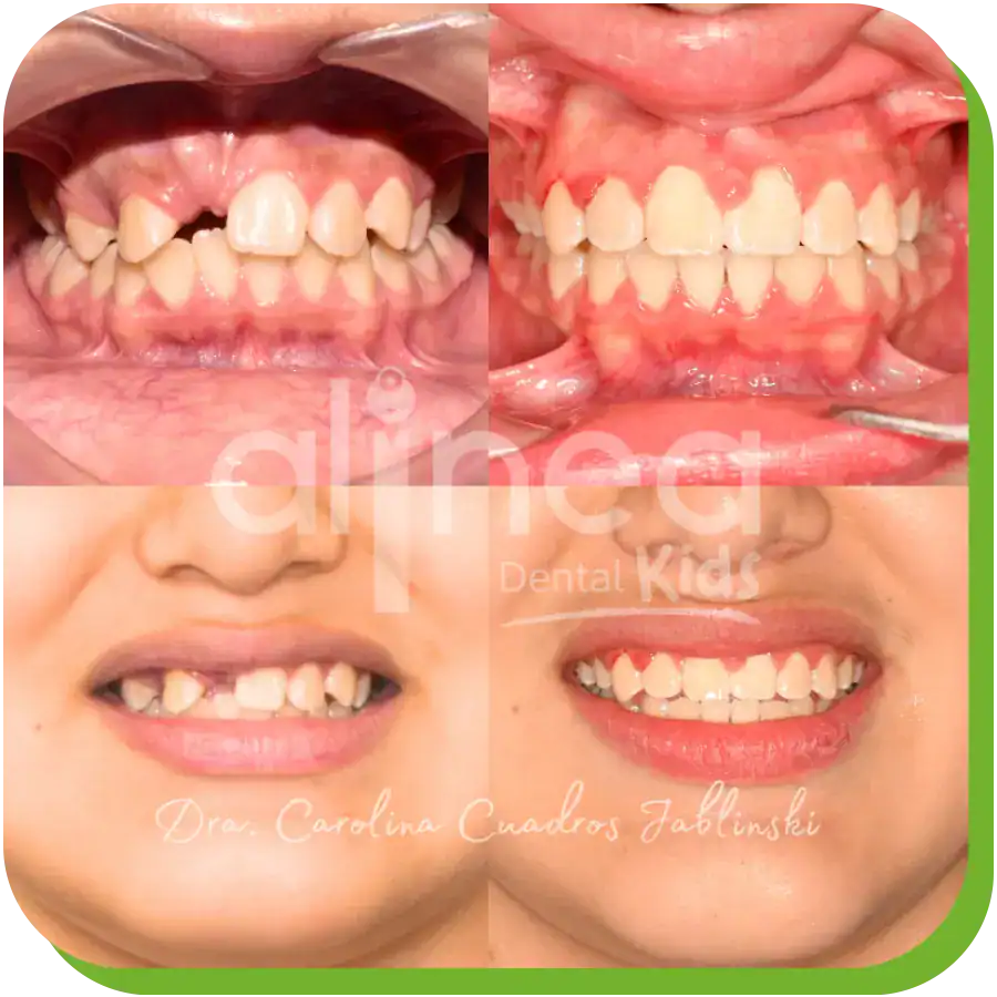 caso dientes retenidos dentista lima peru 3