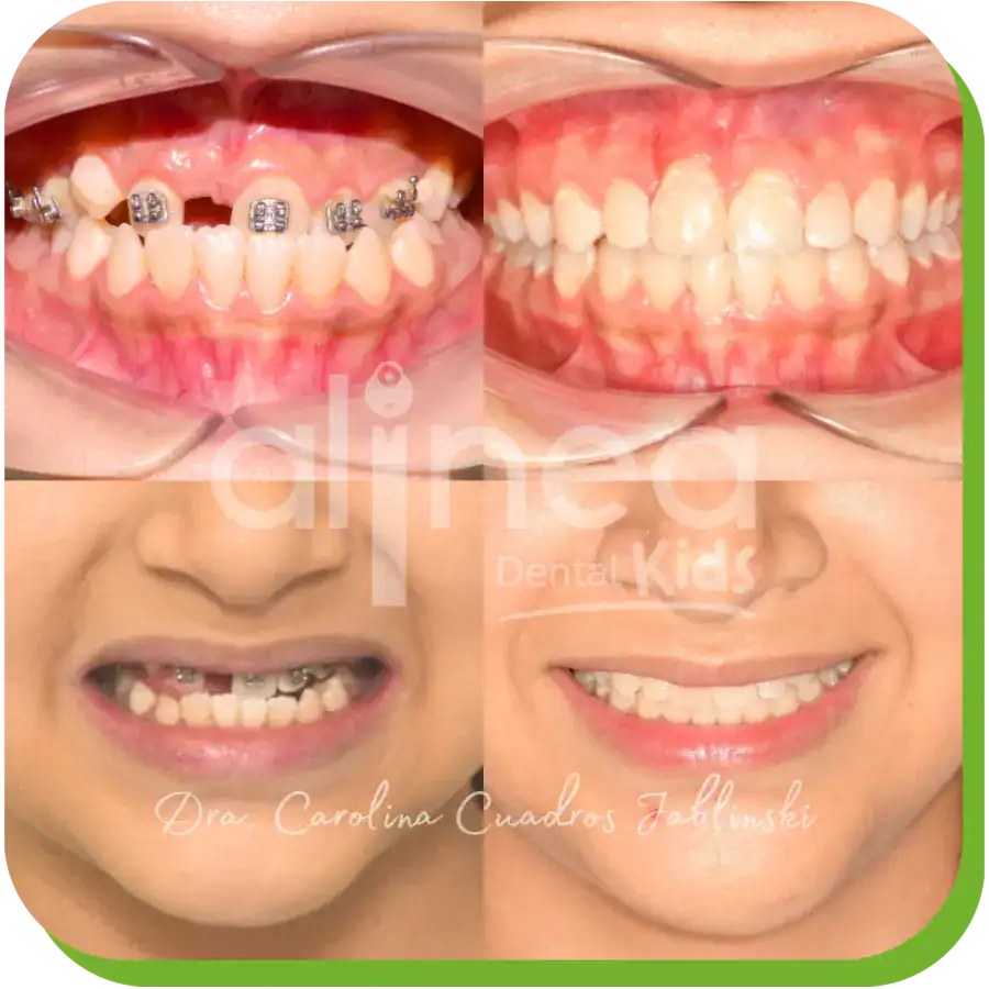 caso dientes retenidos dentista lima peru 4