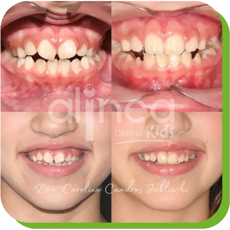 caso resuelto dentista especialista en mordida abierta
