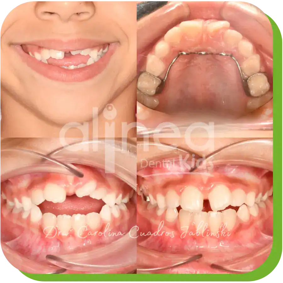 caso resuelto dentista especialista en mordida abierta