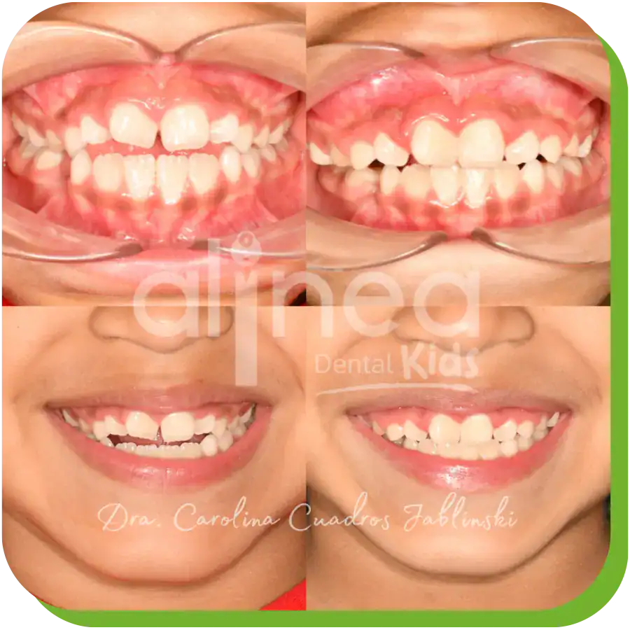 caso resuelto dentista especialista en mordida abierta