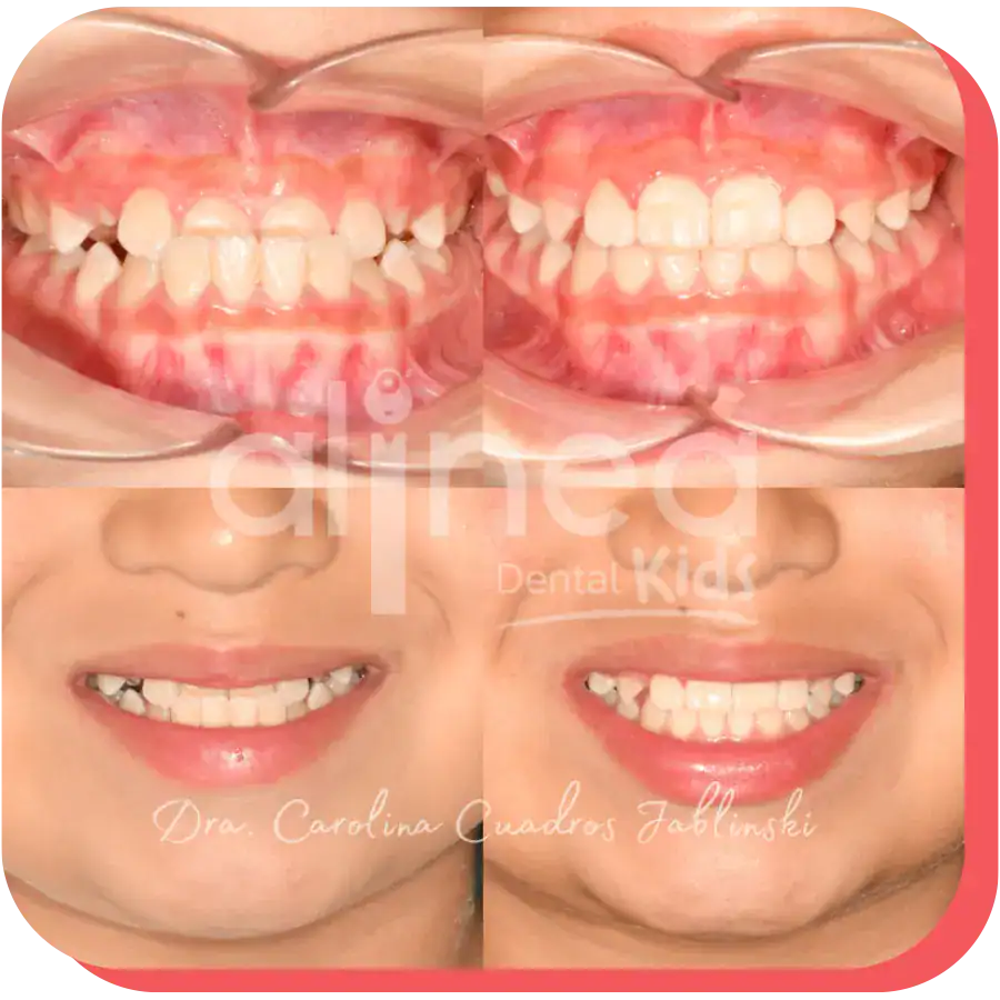 dentista especialista mordida invertida caso resuelto