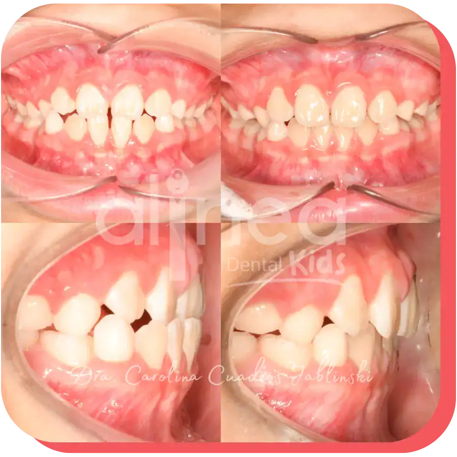 dentista especialista mordida invertida caso resuelto