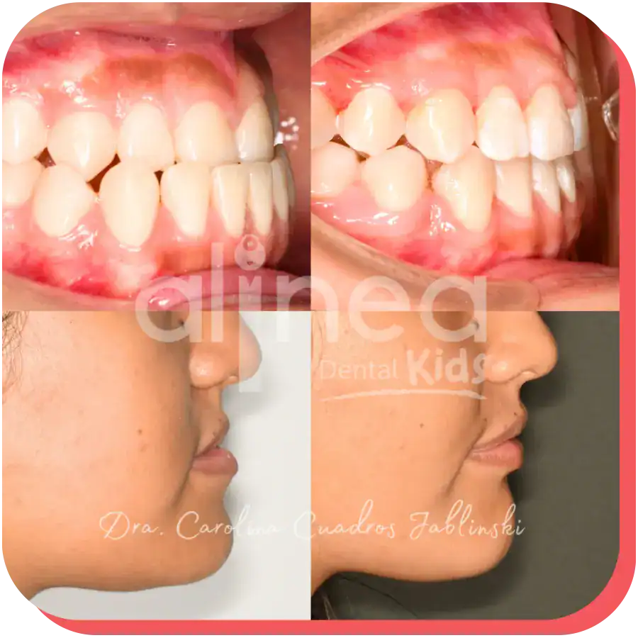 dentista especialista mordida invertida caso resuelto