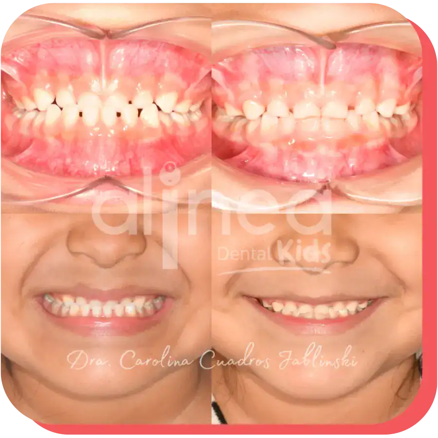 dentista especialista mordida invertida caso resuelto