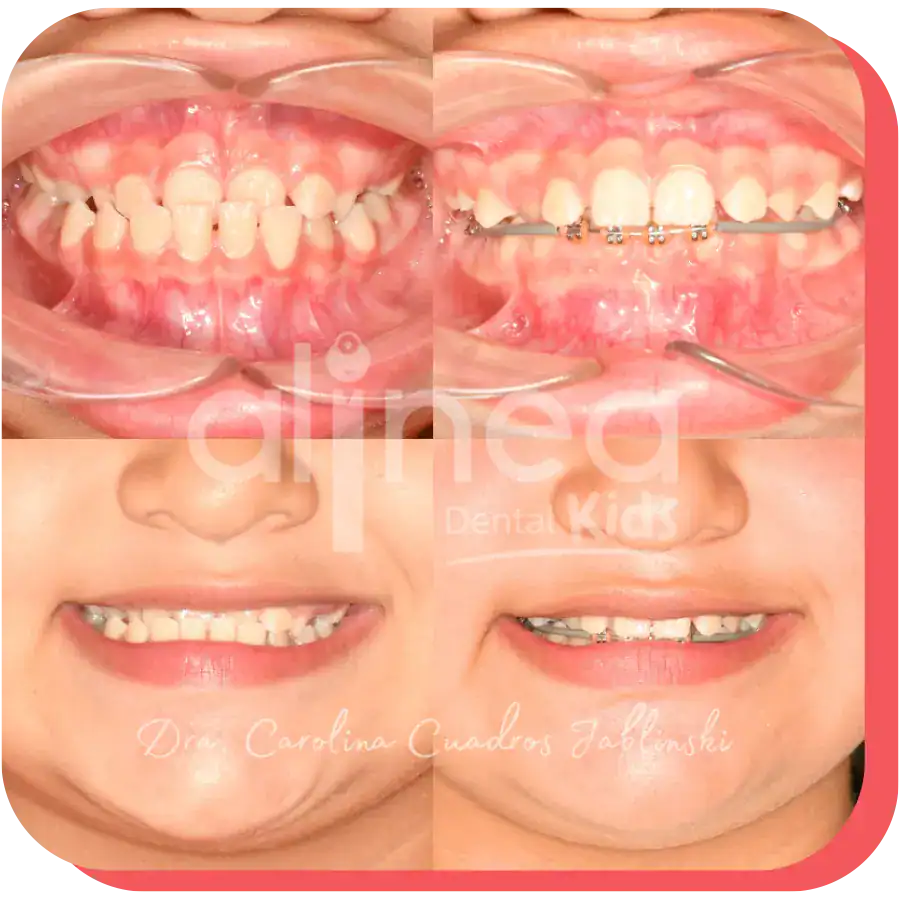 dentista especialista mordida invertida caso resuelto