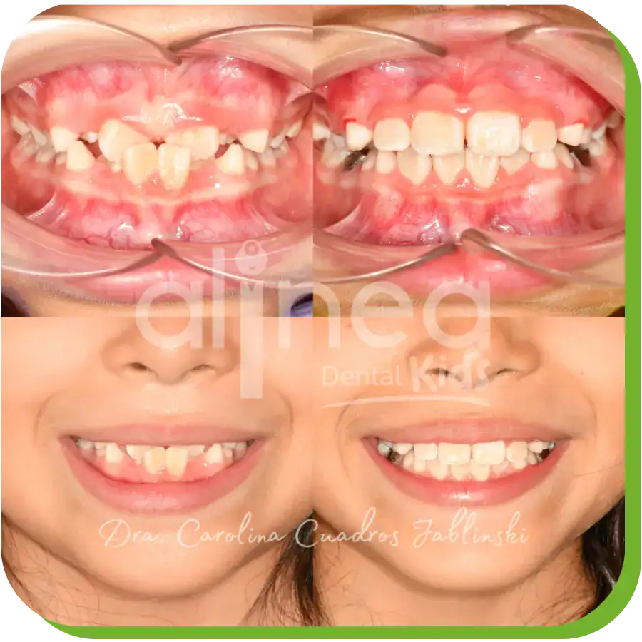 caso odontopediatria apiñamiento dientes lima 2