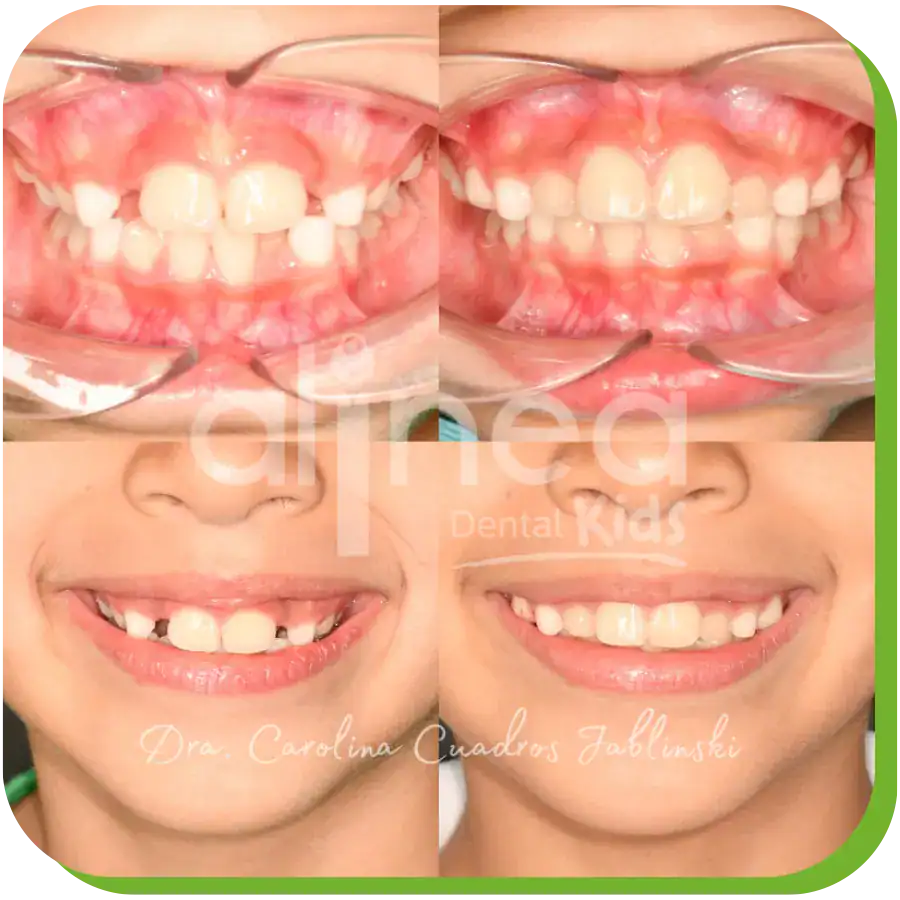 caso odontopediatria apiñamiento dientes lima 3