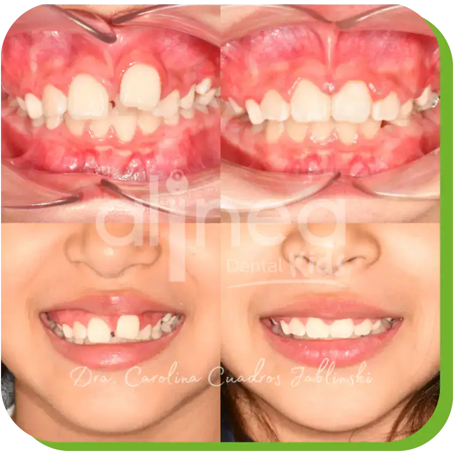 caso odontopediatria apiñamiento dientes lima 4
