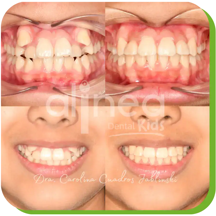 caso odontopediatria apiñamiento dientes lima 5