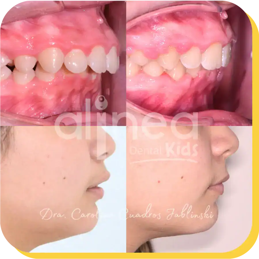 caso protusion dental odontologia lima peru 1