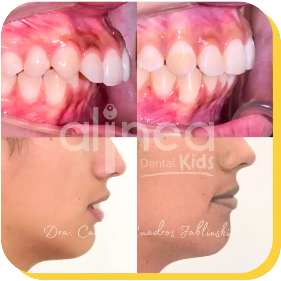 caso protusion dental odontologia lima peru 1