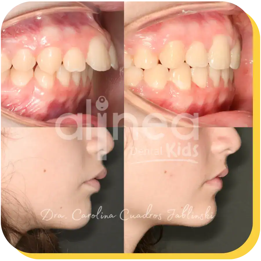 caso protusion dental odontologia lima peru 1