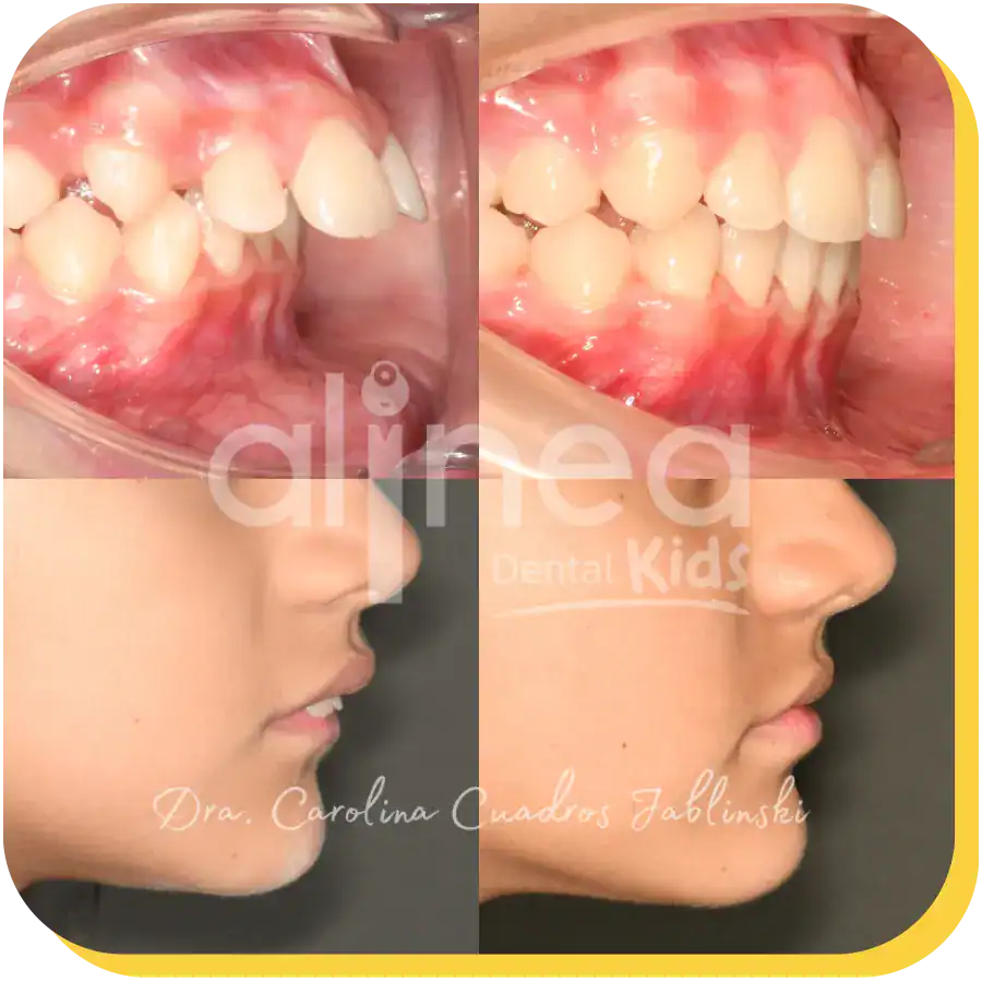caso protusion dental odontologia lima peru 1