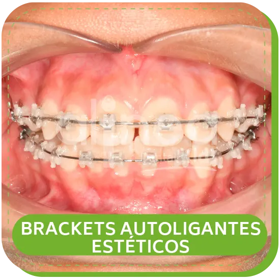 BRACKETS AUTOLIGANTES ESTÉTICOS para niños lima