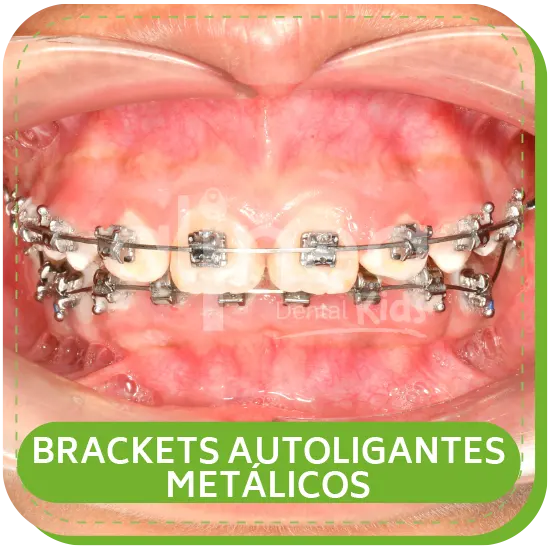 BRACKETS AUTOLIGANTES METÁLICOS para niños lima