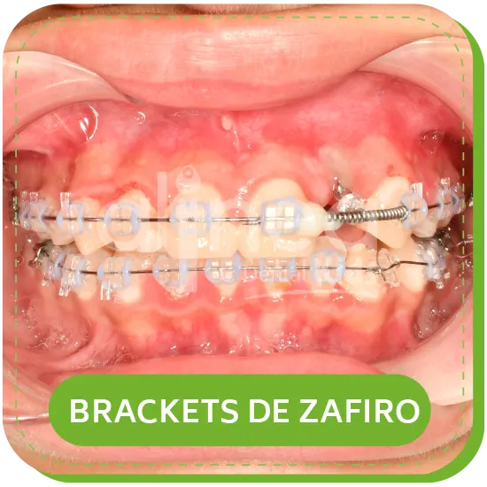 BRACKETS DE ZAFIRO para niños lima