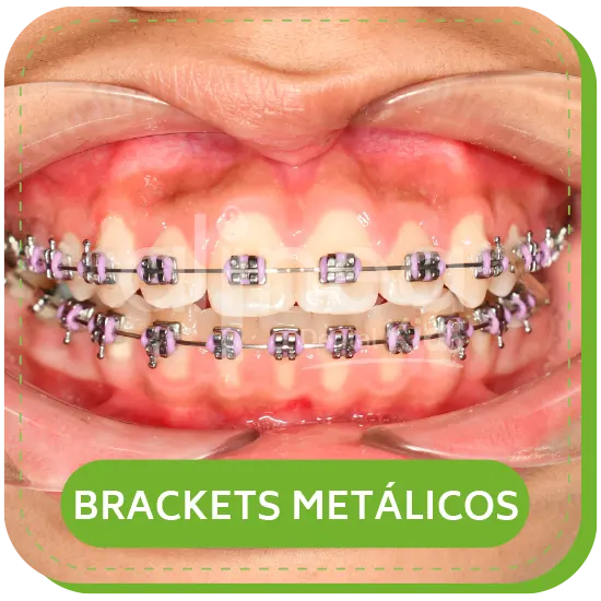 BRACKETS METALICOS para niños lima