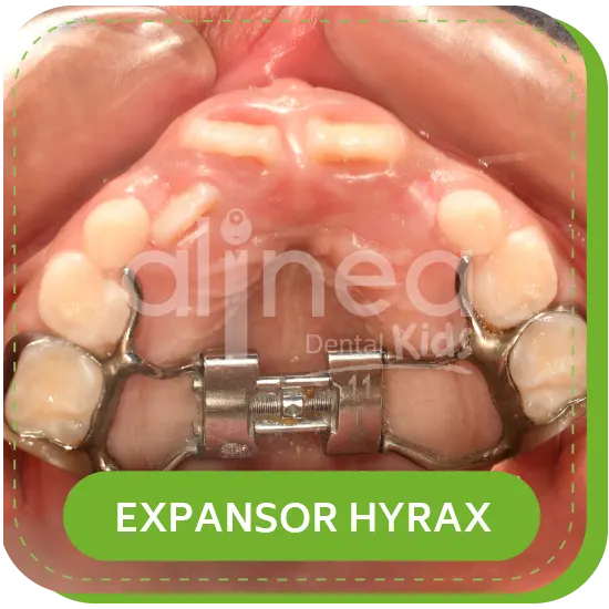 ortodoncia niños EXPANSOR HYRAX lima
