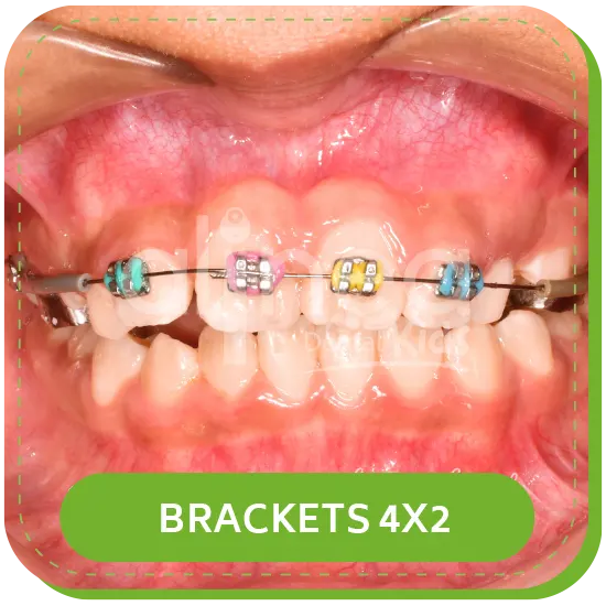 ortodoncia niños infantil BRACKETS 4X2 lima