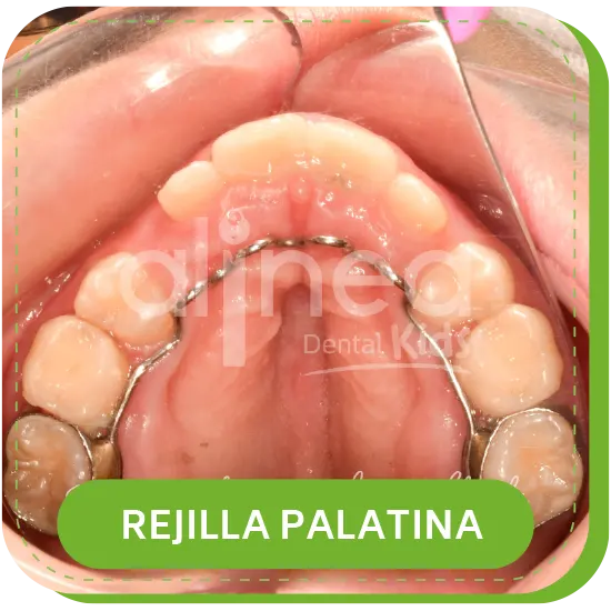 ortodoncia niños infantil REJILLA PALATINA lima