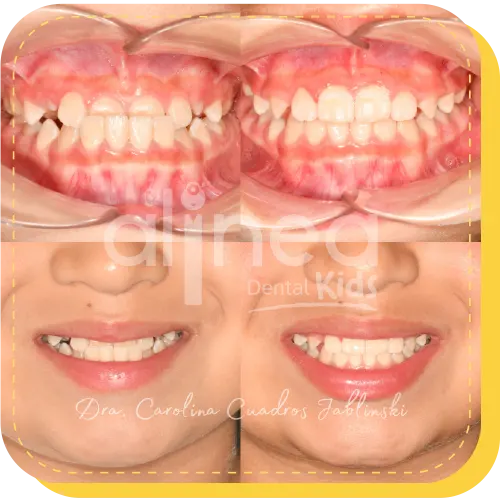 ortodoncia y ortopedia para niños lima