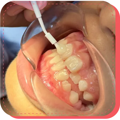 aplicacion de fluor odontopedria lima peru