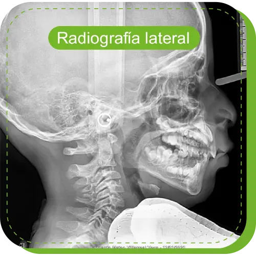 clinica odontopediatria con radiografia lateral surco lima