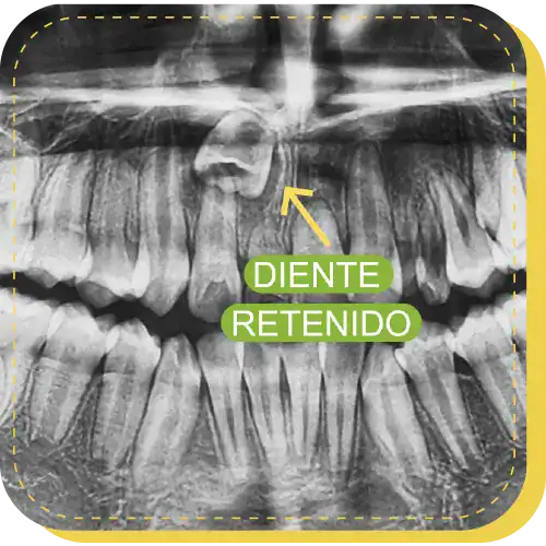 diente retenido