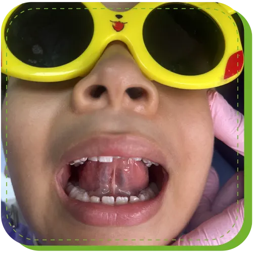 frenectomia labial lingual odontopediatria cirugia surco lima