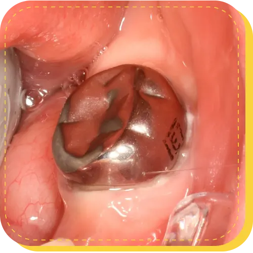 poner un diente de acero metal odontopediatria