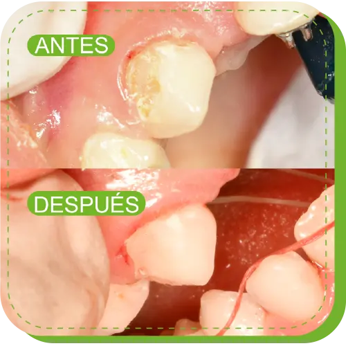 resinas dentales odontopediatra lima peru