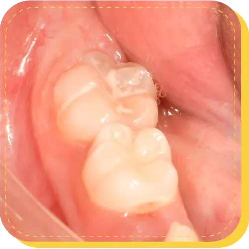 sellantes dentales dentista niños odontopediatria lima