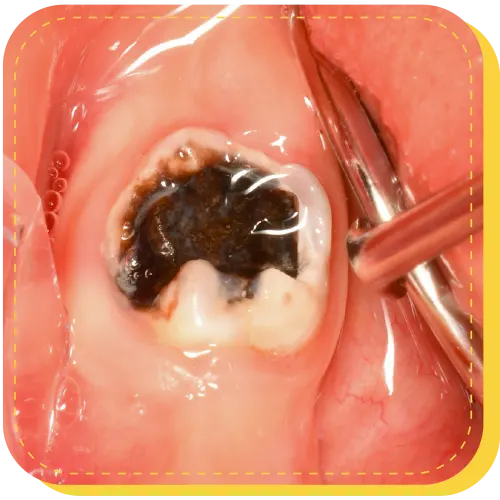 tratamiento con FLUORURO DIAMINO DE PLATA surco lima