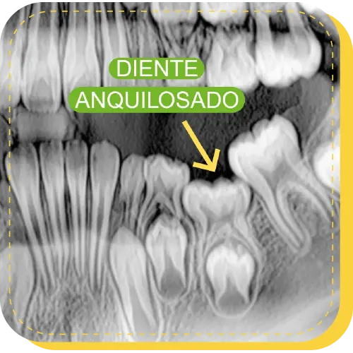 tratamiento diente anquilosado surco lima